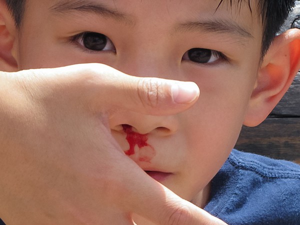 krwawienia z nosa u dzieci