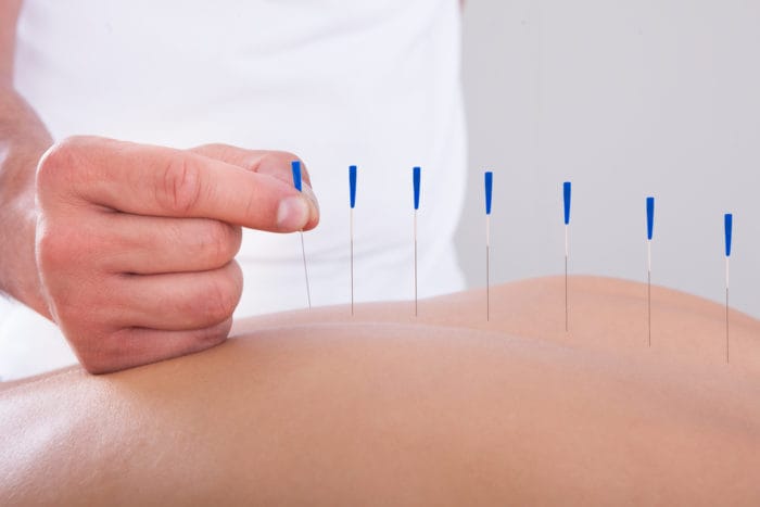 akupunktura łagodzi ból