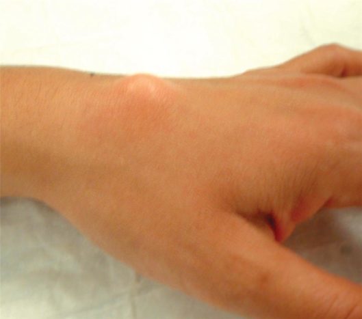 Nadgarstek zwoju nadgarstka górnego nadgarstka (źródło: American Society for Surgery of the Hand)