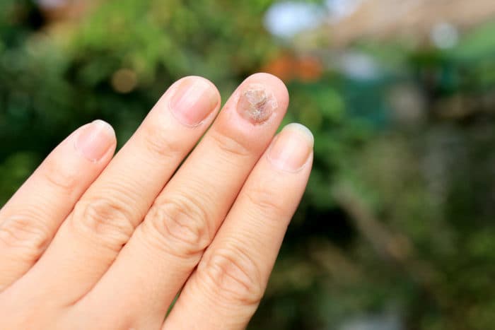 grzybicze zakażenie paznokcia