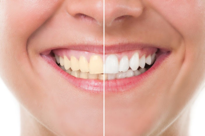 Skutki uboczne wybielania zębów z wybielaniem