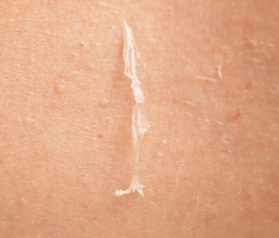 przyczyny pokonywania łuszczącej się skóry