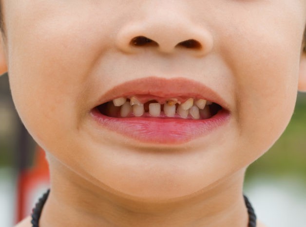 uszkodzenie zębów dzieci