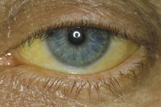 żółte oczy